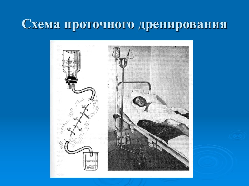 Схема проточного дренирования